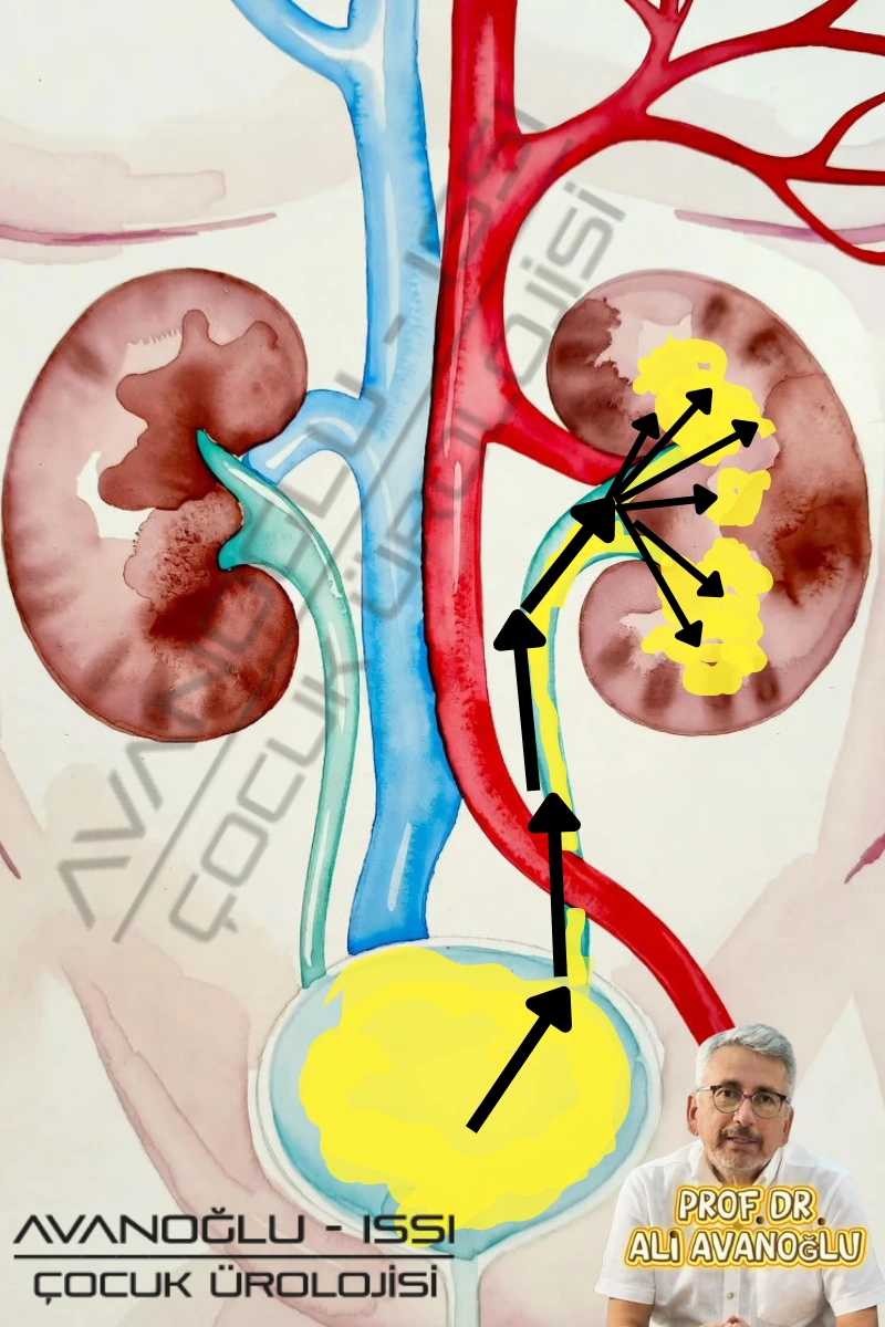 Çocuklarda idrar yolu reflüsü (VUR) hakkında bilgilendirici görsel